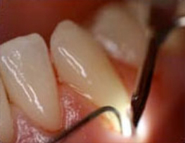 dental tools working on teeth